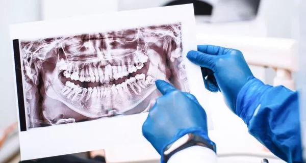 What Is Wisdom Tooth Removal?