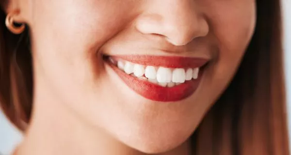 Benefits of dental veneers
