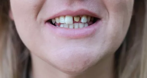 Who are porcelain crowns right for?