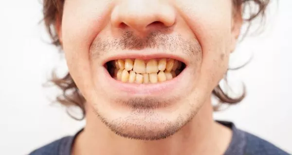 Who is a good candidate for teeth whitening?