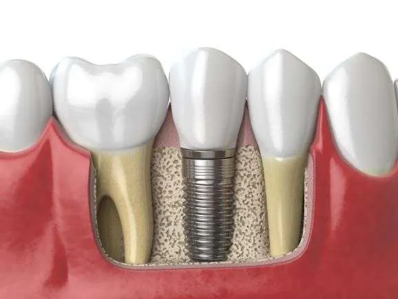 dental implants in newbury park