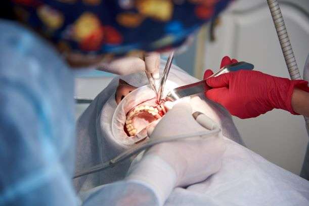 dental extractions