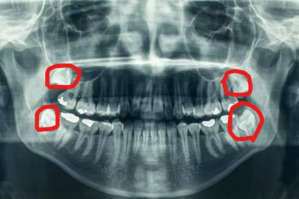 dental extractions