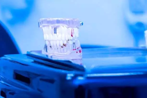 dental implants