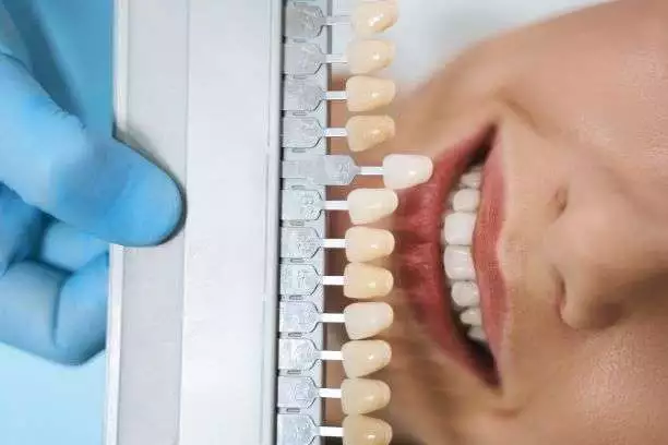 Dental Veneers