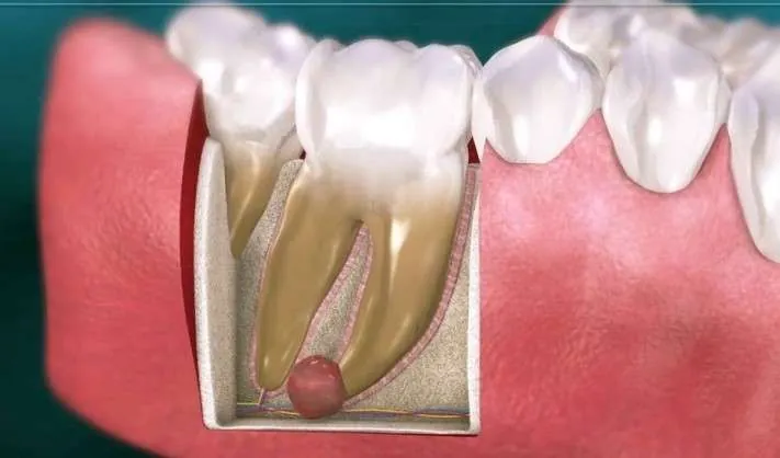 dental implant