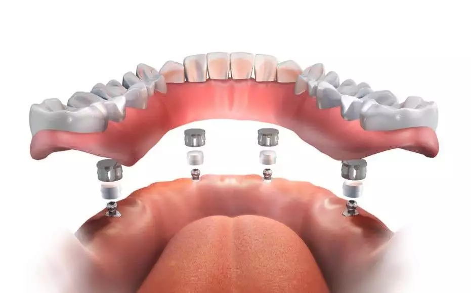 dental bridges