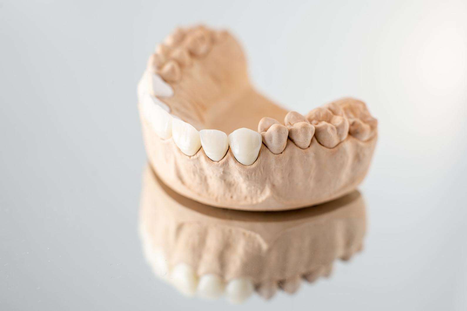 dental crown mold