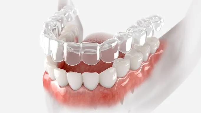 invisalign aligner