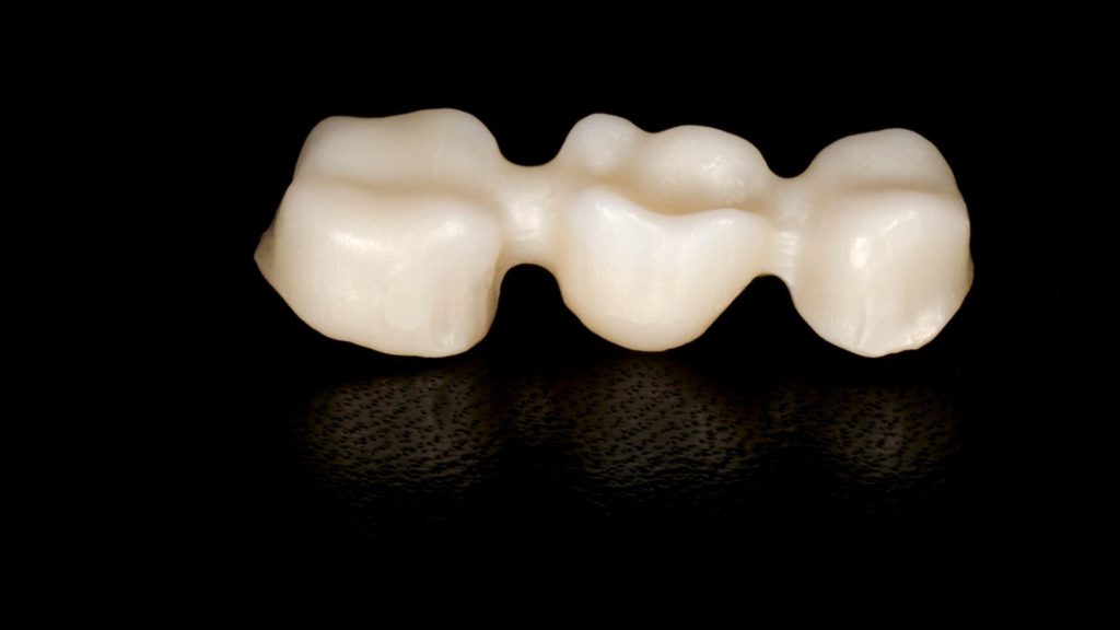 BOCCA Clinicas Dentales - Corona Metal-Porcelana sobre núcleo metálico. Si  se respetan las indicaciones, si se trabaja con materiales de excelente  calidad y si se hace una buena odontología el resultado es