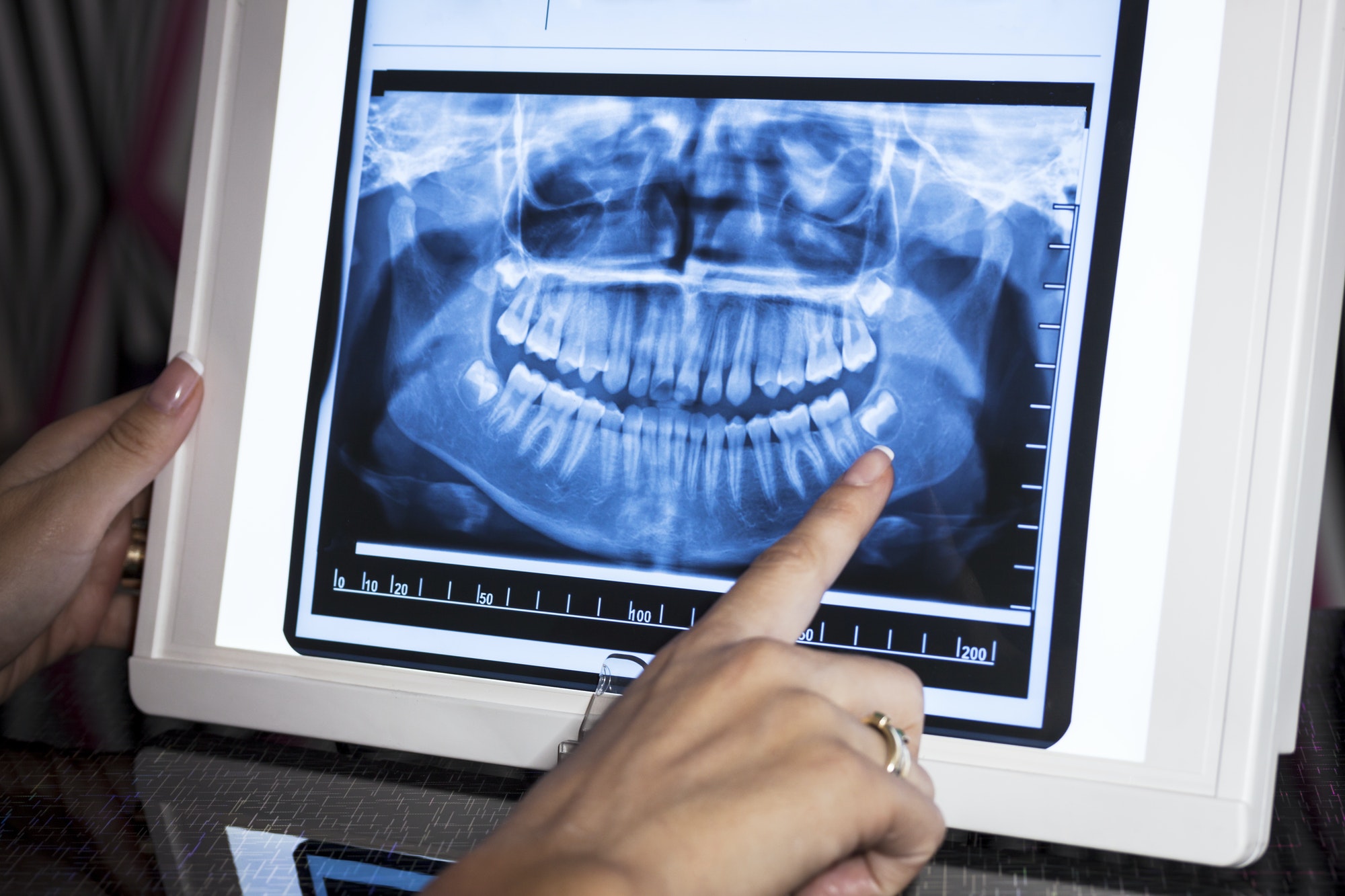 Dental X-Rays - Newbury Park