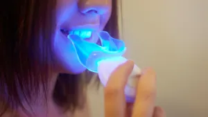 laser teeth whitening with zoom