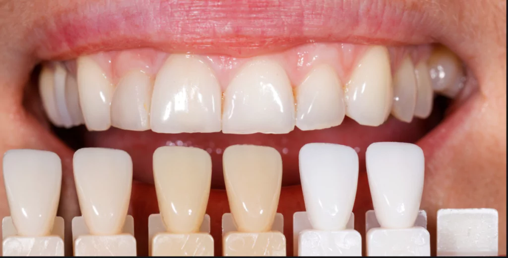 Dental Veneers