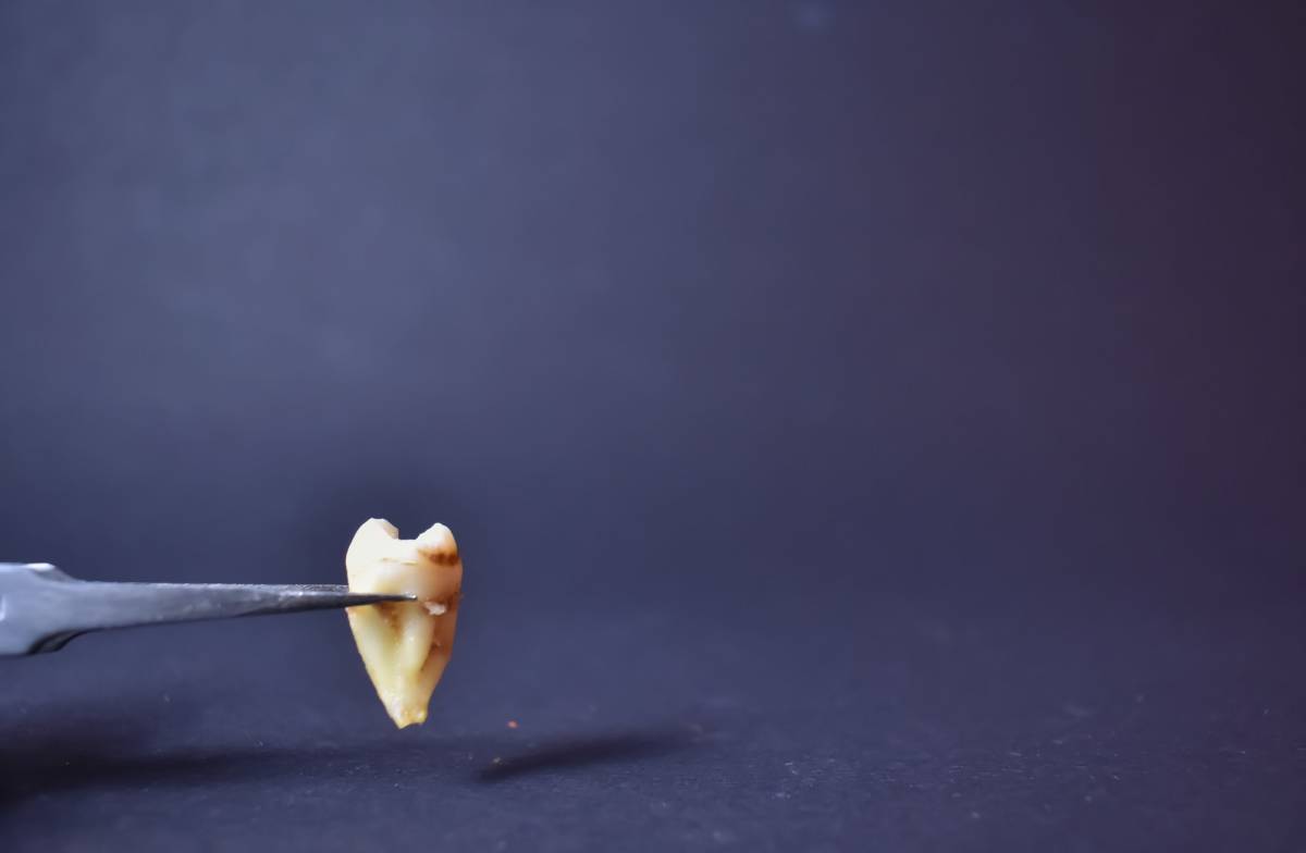 A Closeup Selective focus Picture of a Human Molar Teeth or Wisdom tooth Extracted with Root Visible