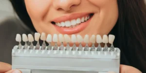 Carillas Dentales en Thousand Oaks | Sonrisa Perfecta